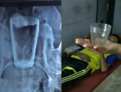 Glass Cups Enter Jember Men's Stomach There are Elements “mystical”? Here's the Doctor's Explanation